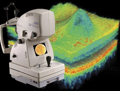 OCT – Tomografia de Coerência Óptica